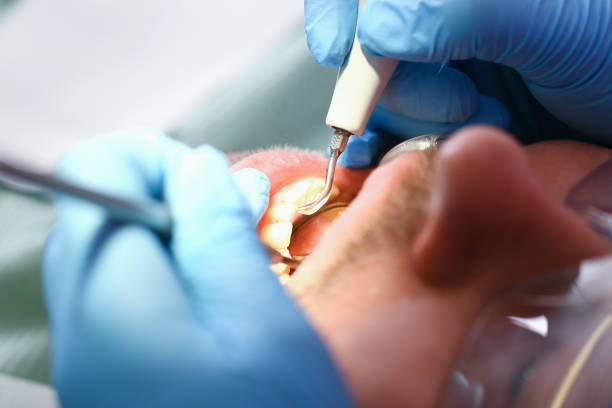 Best Emergency Root Canal Treatment in Concord, NH