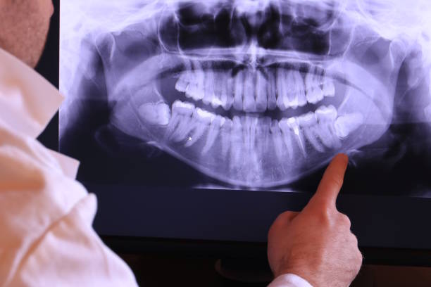 Best Emergency Tooth Extraction in Concord, NH