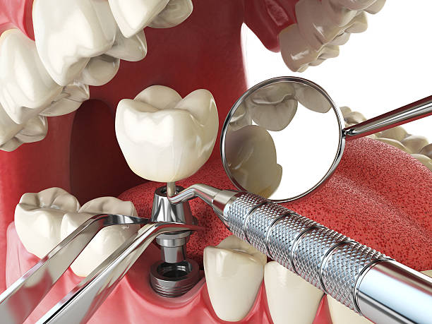 Best Emergency Wisdom Teeth Removal in Concord, NH